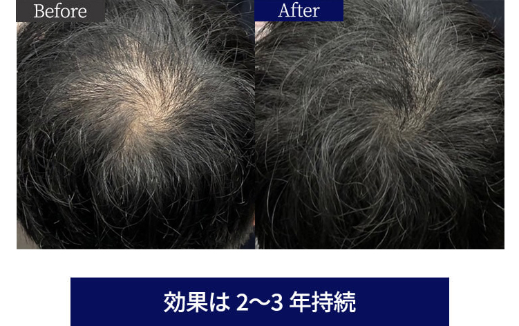 before after 効果は2〜3年持続