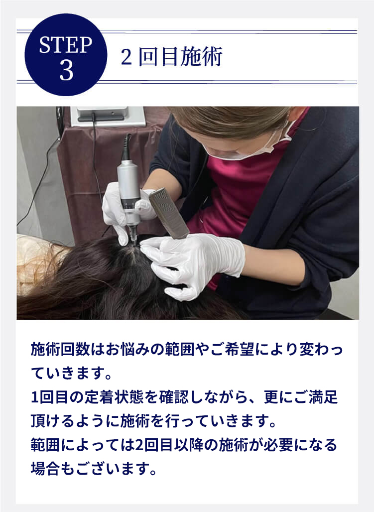 STEP3 2回目施術 施術回数はお悩みの範囲やご希望により変わっていきます。１回目の定着状態を確認しながら、更にご満足いただけるよう施術を行っていきます。範囲によっては、２回目以降のの施術が必要になる場合もございます。
