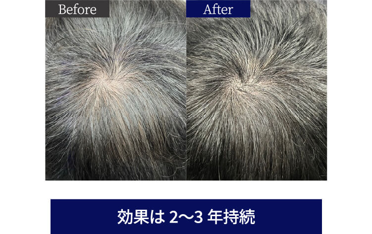 before after 効果は2〜3年持続