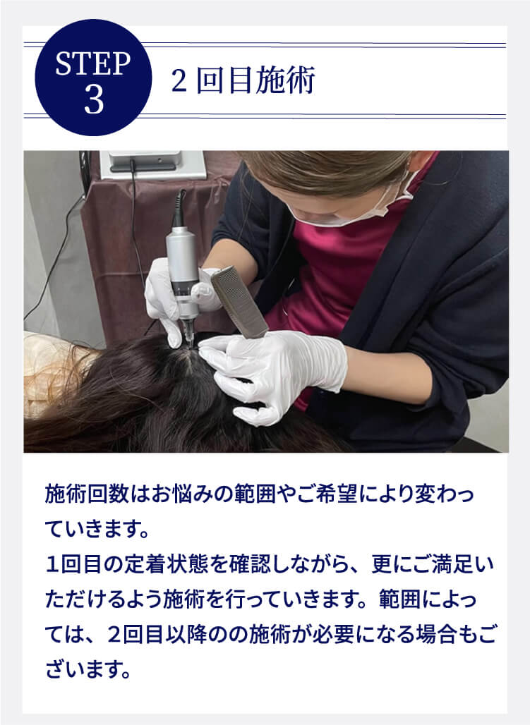 STEP3 2回目施術 施術回数はお悩みの範囲やご希望により変わっていきます。１回目の定着状態を確認しながら、更にご満足いただけるよう施術を行っていきます。範囲によっては、２回目以降のの施術が必要になる場合もございます。